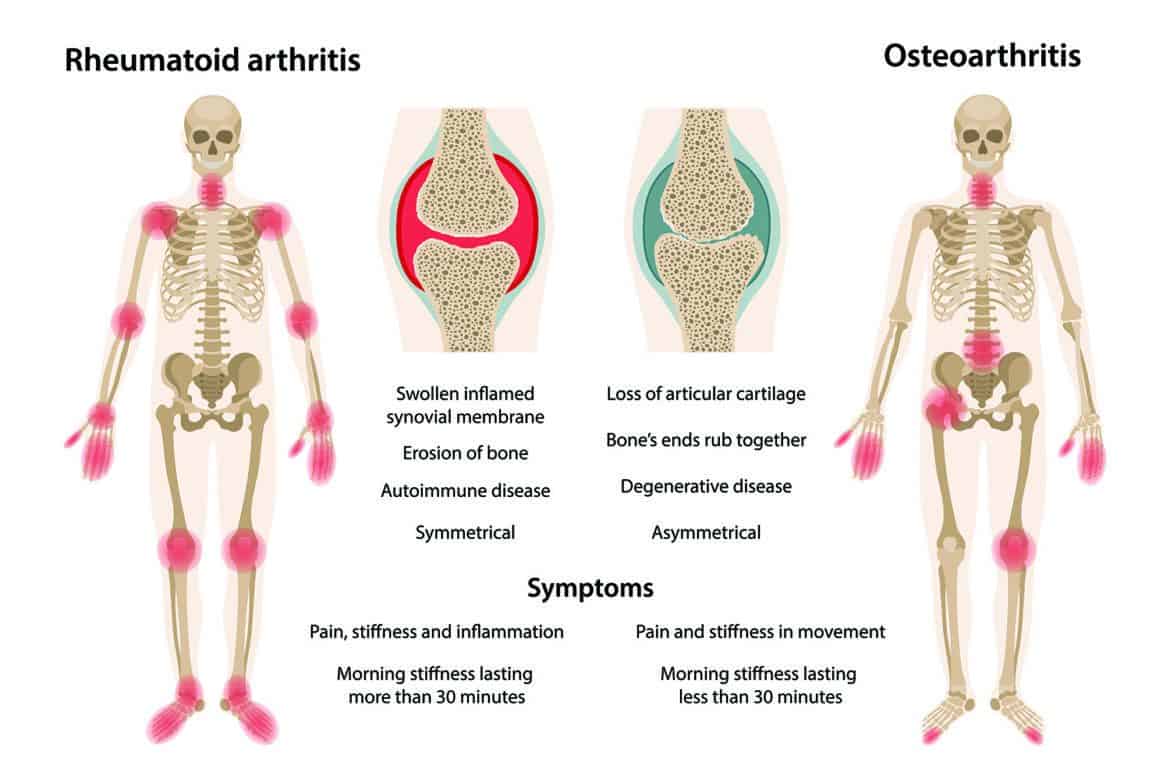 Is It Osteoarthritis or Rheumatoid Arthritis? | JointFuel360 Official