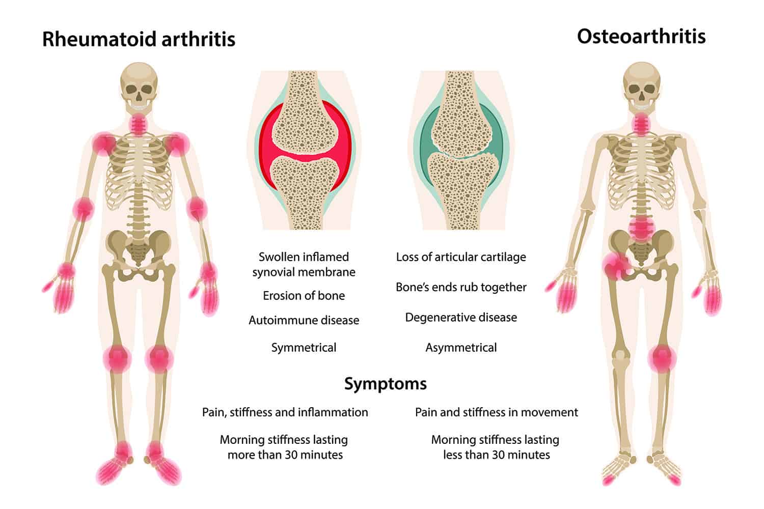 Osteoarthritis Rheumatoid Arthritis 